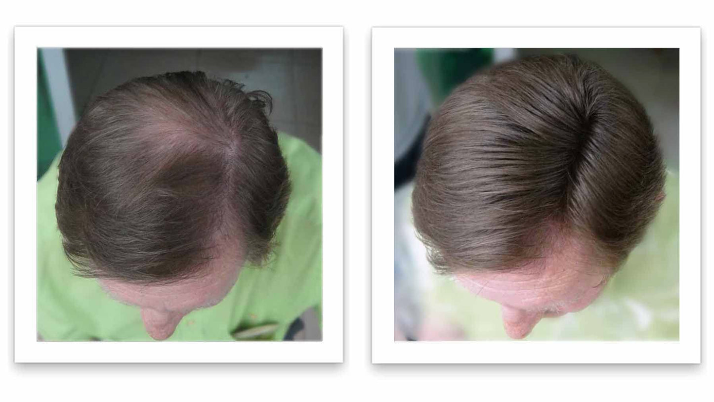 Caboki Hair Loss Concealer (All-Natural Hair Building Fibers) Travel Size (Medium Brown)
